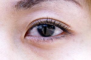 脂肪吸引とはどのようなものなのか